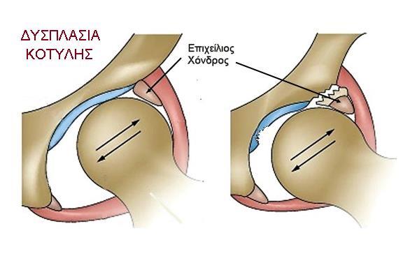 acetabular rims syndrome Klaue