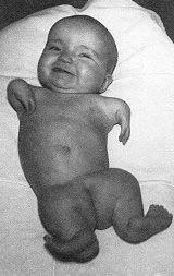 Ιζμμένεηα D-thalidomide: morning sickness drug L-thalidomide: teratogen (D+L = racemic) A thalidomide baby 1964: Jacob
