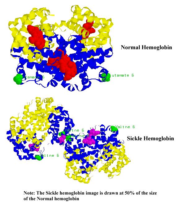 Δξεπαλνθπηηαξηθή Αλαηκία (Sickle cell anaemia,