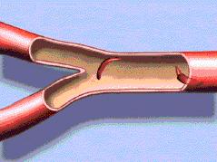 Capillary