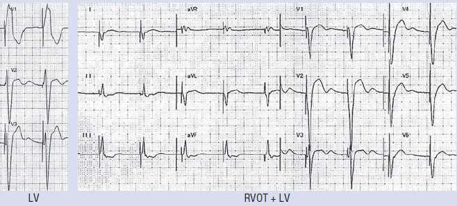 ECG DURING BIV PACING / RVOT +