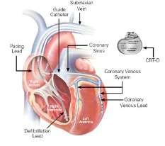 FACTORS ASSOCIATED WITH SUPERRESPONSE TO CRT Independent factors after multivariate analysis Duration of HF symptoms <12 months 1 LBBB 2 LA volume <55 ml, global