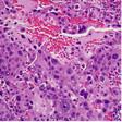 intrinsic subtypes, all of the claudin-low bladder tumors are a subpopulation of the basal-like subtype.