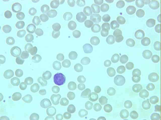 Extravascular haemolysis PROFILE Hb 103 g/l x RCC 3.33 10 12 / Hct 0.305 L MCV 92 fl MCH 30.