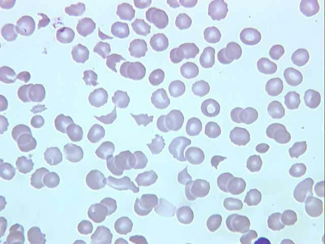 0 10 9 /L Intravascular haemolysis PROFILE Hb 84 g/l x RCC 2.86 10 12 / Hct 0.