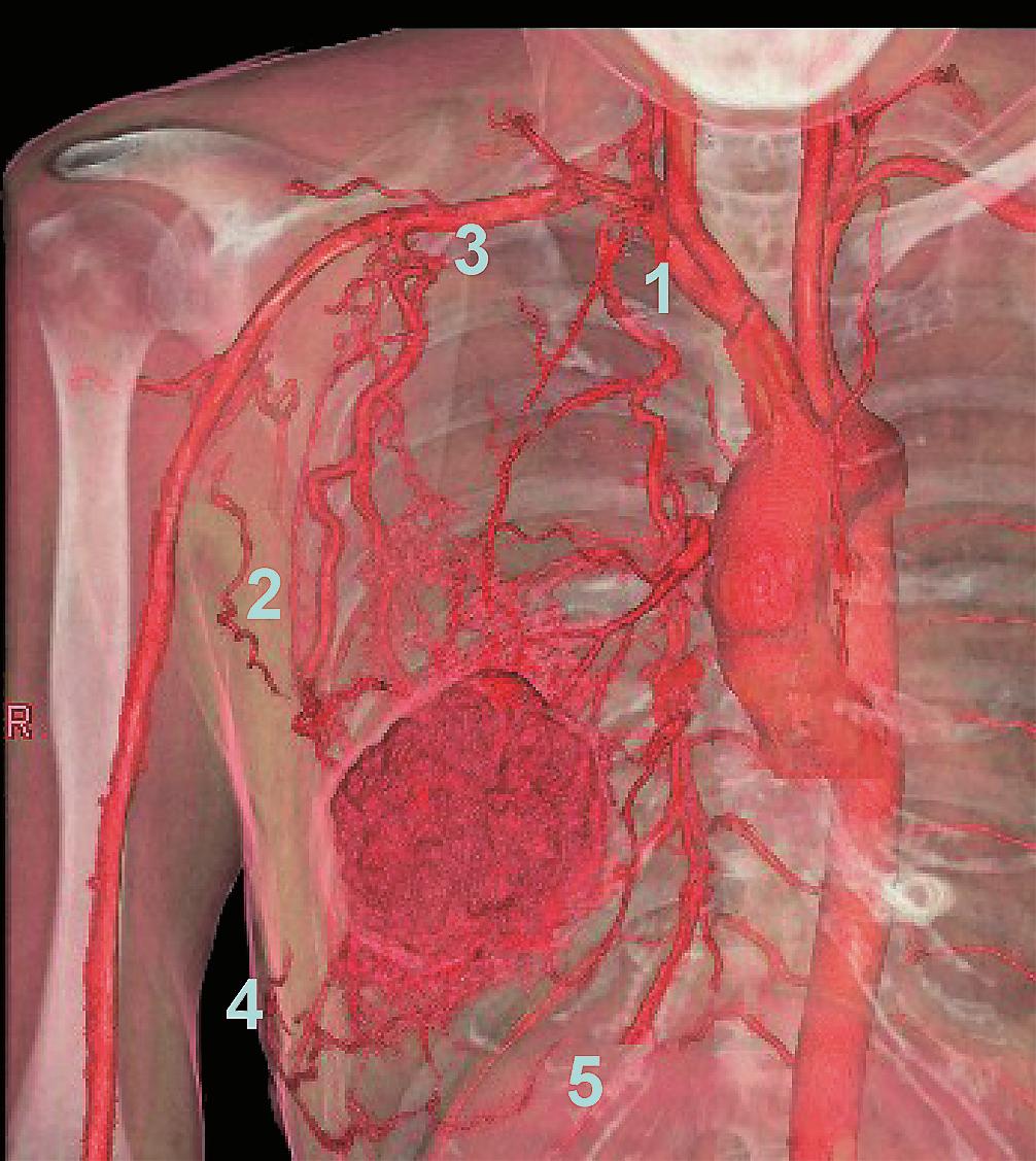 UV»¼ 168 W X E Fig. 2 Arterial infusion using a blood pressure cu# &%i&- Aῌ 2 NOP j ST+U+' (k @ l )m -no ;pq* 5 ῌ `ak NBCA -+,r&'st, Fig. 1 3D-CT during Left ventriculography 1.