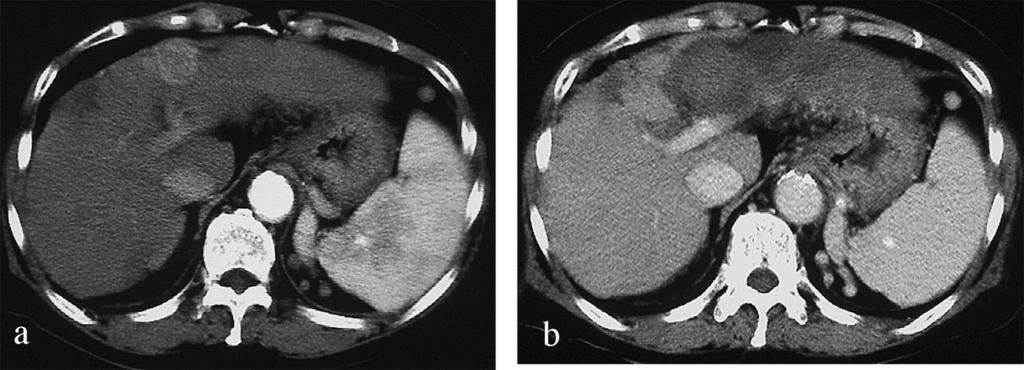 96 10 RFA a: S4 2.5 cm HCC b: RFA HCC QOL RFA real time 1 Shiina S, Imamura M, Omata M: Percutaneous ethanol injection therapy PEIT for malignant liver neoplasms.