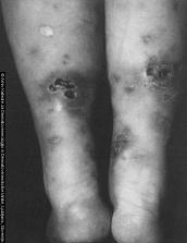 Mikidi So nenalezljivi kožni izpuščaji, nastali zaradi alergijske reakcije na primarno glivično okužbo kože. V predelu mikidov ne najdemo gliv.