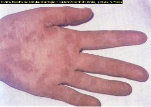45. Sistemski lupus eritematosus (SLE). Je avtoimunska bolezen pri kateri nalaganje imunskih kompleksov na dermoepidermalni meji in v steni žilja sproži vnetje.
