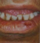 Ploščatocelični karcinom spodnje ustnice. 72. Bazaliom.