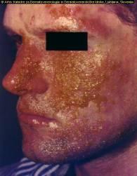 4. Stranski učinki retinoidov. Najpogostejše težave so suha koža, ki se lušči, je razpokana in srbi, suha in vneta sluznica ust in očesne veznice.