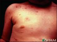 Manjše število mastocitov je vedno v normalni koži, predvsem okrog kapilar v bližini epidermalnih adneksov. Zanje so značilna metakromatska zrna s histaminom, heparinom in nekaterimi encimi.