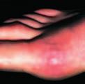 Arthritis Research UK Figure 1 affecting the big toe most commonly affects the big toe. The joint becomes red, hot, swollen and extremely painful.