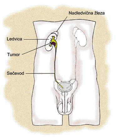 V takem primeru je pregled mehurja nujen. V redkih primerih pa najdemo hkrati ob tumorju ledviënih celic πe tumor mehurja.