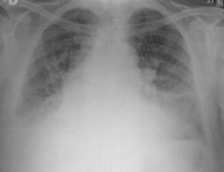 radioloogiline leid mõlemad Infektsioossed haigused: Äge bronhiit Kroonilise bronhiidi kroonilise obstruktiivse kopsuhaiguse (KOK) ägenemine Kopsutuberkuloos (eeskätt infiltratiivne ja koldeline,