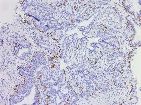 cell layer in PIN lesions.