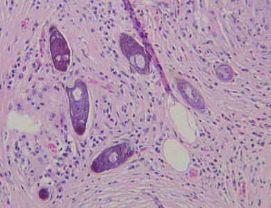 Ouă de Schistosoma în ţesuturi (HE) S. mansoni S. japonicum Epidemiologie Gazda intermediară S. haematobium, S.