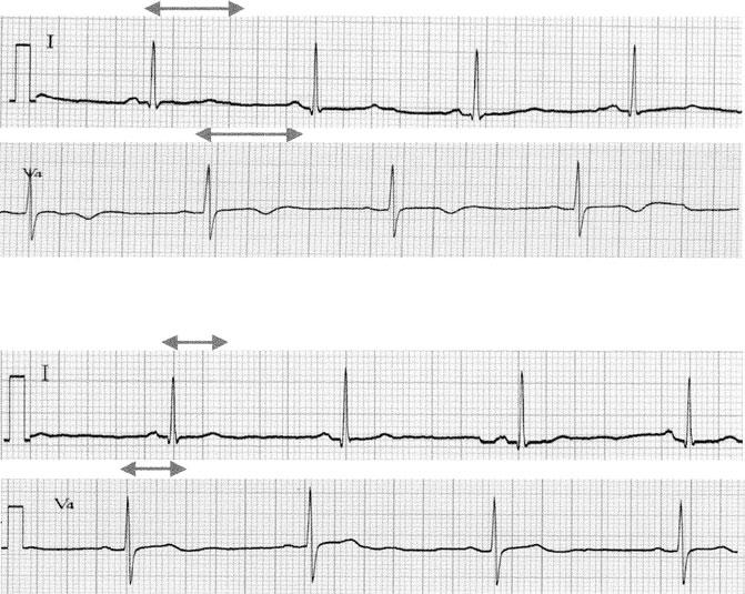 49 3a 3b Figure 3. Heart rate is 52 min and sinus bradycardia 3a. Twave is inverted in V5, and myocardial injury was suspected. QT prolongation is also seen. QT time was 533 ms 3a.