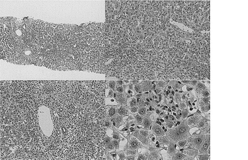 4 predonisolone QT ST-T Fig. 3-b, QT 45 N-nitoroso-fenfluramine, fenfluramine 45D-LST cpm, S.I.22 Fig. 5: P-C bridging necrosis piecemeal necrosis P-C bridging necrosis Figure 5.