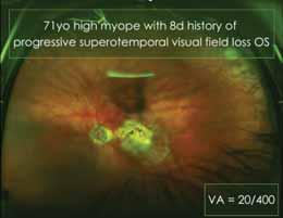 Successful repair of myopic MHRD was achieved in all 2.