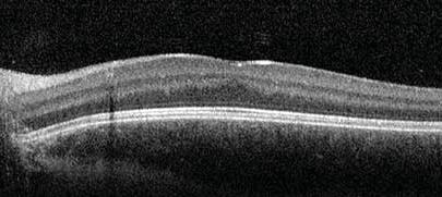 RPE/ Bruch s Complex Ellipsoid Zone Interdigitation Zone Choroid Sclera Junction