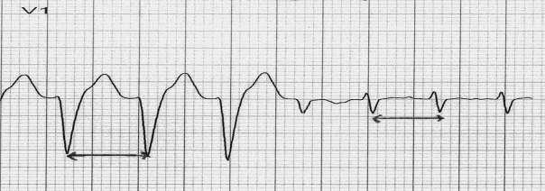 ΓΔΜΑΣΙΟ) - LBBB