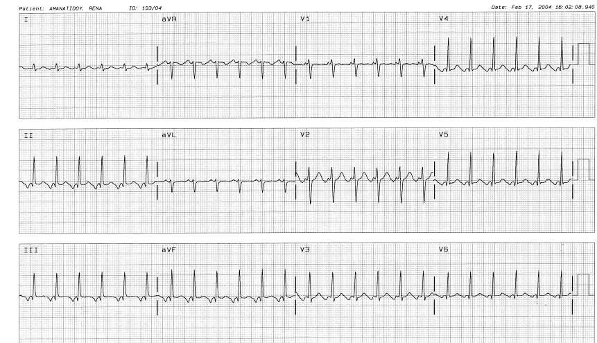 LONG RP SVT-PJRT (paroxysmal