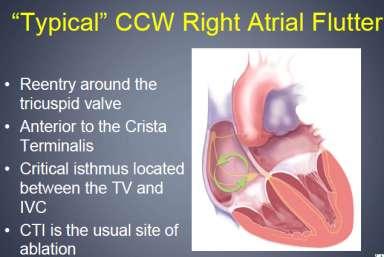ATRIAL FLUTTER 1.