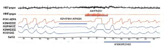 Εικόνα 2. Πολυπνογράφημα που απεικονίζει καταγραφή 60 sec με μια Κεντρική άπνοια. Δεν υπάρχει ροή αέρα ούτε κινήσεις θώρακος και κοιλίας.