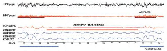 ΓΕΝΙΚΟ ΜΕΡΟΣ Ορισμοί Σύμφωνα με τον ΠΟΥ, το ΣΑΑΥ είναι μία κλινική διαταραχή που χαρακτηρίζεται από επαναλαμβανόμενα επεισόδια απόφραξης του ανώτερου αεραγωγού που οδηγεί σε αξιοσημείωτη μείωση