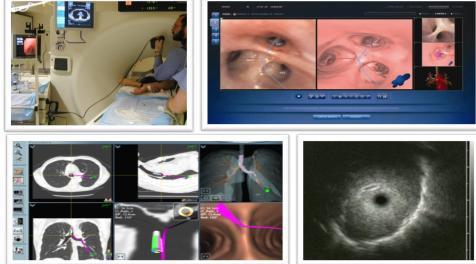 Radial endobronchial ultrasound (rebus) (sens 73%) Electromagnetic navigation (sens 71%) CT guided fluoroscopy (sens 65%) Navigation bronchoscopy Ultrathin