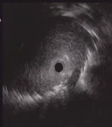 (grade 1C) Lung adenocarcinoma