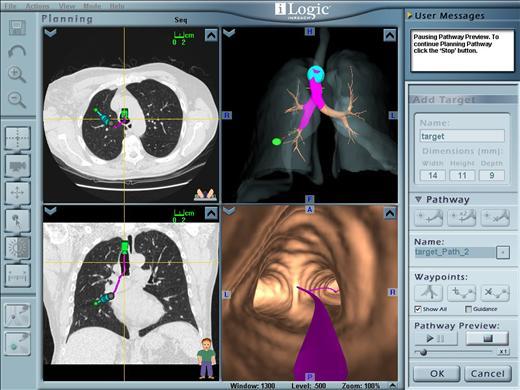 Electomagnetic navigation και Navigation bronchoscopy Electromagnetic
