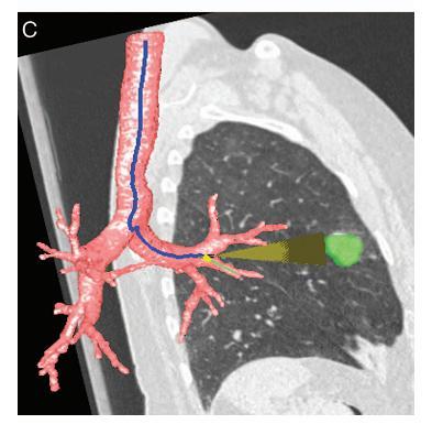 και real time 3D CT εικόνες σε σημείαστόχους στο βρογχικό δένδρο