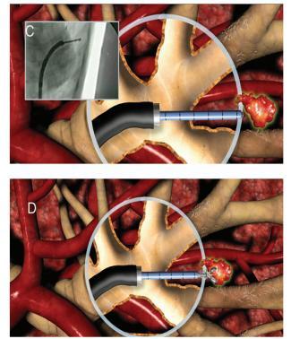 bronchoscopy virtual bronchoscopic pathway στο σημείο-στόχο Virtual
