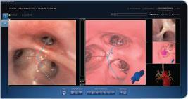 rebus Bronchoscopic transparenchymal nodule access Makris D et al.