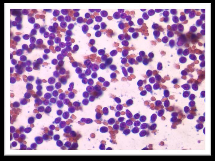 Rapid On site Evaluation - ROSE Xρώση επίστρωσης με Merck s Hemacolor ή χρώση ταχεία Παπανικολάου Δεν επηρεάζει τη διαγνωστική ακρίβεια της TBNA