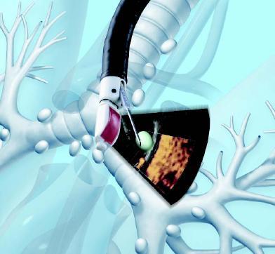 Endobronchial (EBUS) και