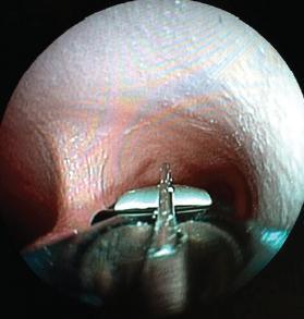 curved ultrasound transducer