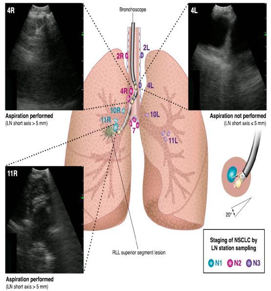 Endosonography για τη σταδιοποίηση Ν του ΜΣΘ EBUS: sensitivity 84-89%, specificity 100%, PPV