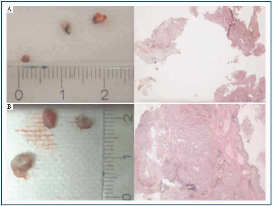 Ενδοβρογχική κρυοβιοψία/cryobiopsy Ασφαλής τεχνική