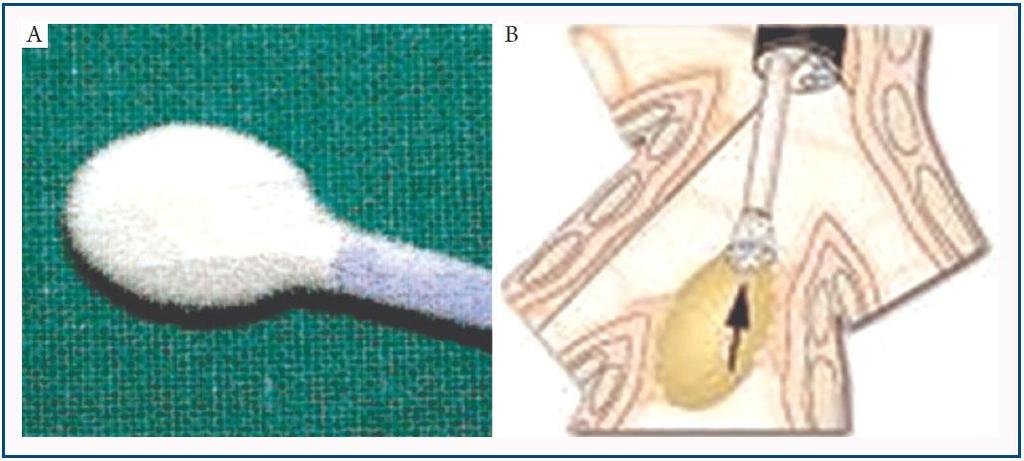 ιστοτεμαχίδια Λιγότερα artifacts Muley T et al.