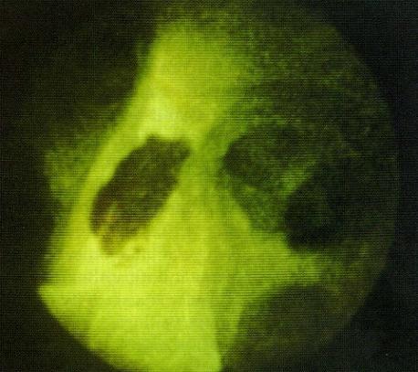(NBI) AFB - videobronchoscopy και
