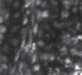 fluorescin (χρωστική ουσία) Διάγνωση καρκινικών αλλοιώσεων (sensitivity 96.