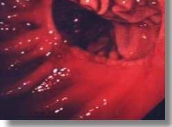 υσαπορρόφηση µετά χειρουργικές επεµβάσεις (1) Γαστρεκτοµή-βαγοτοµή γαστρικής οξύτητας βακτηριδιακή υπερανάπτυξη έκκρισης πεψίνης βακτηριδιακή υπερανάπτυξη