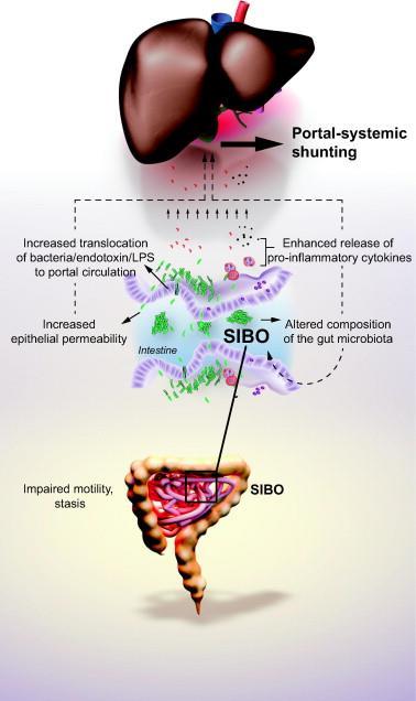 Σχέση μικροβιώματος και ηπατικών νοσημάτων Παθοφυσιολογία Διαταραχές του μικροβιώματος του εντέρου Διαταραχές κινητικότητας εντέρου - στάση