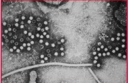 Hepatitis E Virus Κλινικά και επιδημιολογικά παρόμοιος με τον HAV Οι επιδημίες αφορούν κυρίως νέους 15-40 ετών Μεγάλες επιδημίες έχουν αναφερθεί στην Αφρική, Μεξικό,