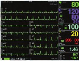 makera ISO 9001 0123 ECG+SpO 2 +NIBP+ESP+ opciono 2TEMPEATUE, 2 IBP i EtCO 2 modul 33777 Analize aritmija: VTAG, VFIB, ASY- STOLIC pesmejker određivanje uključuje na ECG talasastom displeju 33737