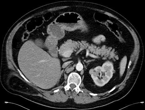 CT: Multiple small focal lesions the 2 largest