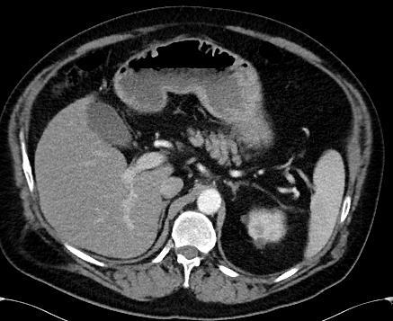 <10HU Smaller lesions difficult to determine